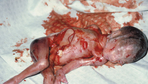abortus